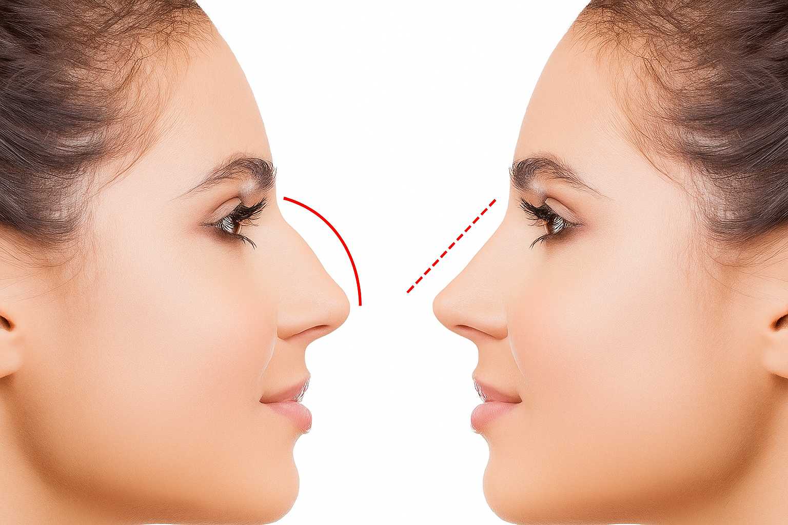 piezo rinoplastika